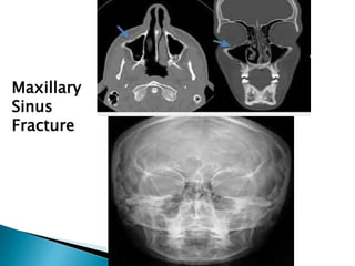 Maxillary
Sinus
Fracture
 