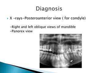 X –rays-Posteroanterior view ( for condyle)
-Right and left oblique views of mandible
-Panorex view
 
