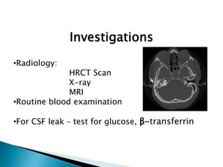 Investigations
•Radiology:
HRCT Scan
X-ray
MRI
•Routine blood examination
•For CSF leak – test for glucose, β-transferrin
 