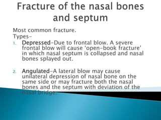 Most common fracture.
Types-
1. Depressed-Due to frontal blow. A severe
frontal blow will cause ‘open-book fracture’
in which nasal septum is collapsed and nasal
bones splayed out.
2. Angulated-A lateral blow may cause
unilateral depression of nasal bone on the
same side or may fracture both the nasal
bones and the septum with deviation of the
nasal bridge.
 