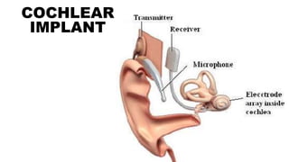COCHLEAR
IMPLANT
