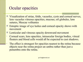 Ocular opacities
 Visualization of striae, folds, vacuoles, cysts and corneal nerves,
  lens vacuoles vitreous opacities, mucous, oil globules, lens
  sutures, Muscae volitantes
 Entoptic image of eye lashes and corneal opacity shows with
  movement
 Lenticular and vitreous opacity downward movement
• Corneal scars, lens opacities, intraocular foreign bodies, vitreal
  floaters and blood cells would all be expected to cast shadows.
• The effect is strongest for opacities nearest to the retina because
  objects near the retina project an umbra rather than just a
  penumbra onto the retina.

                             gs101lg@hotmail.com
 