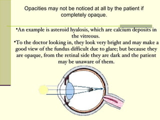 Opacities may not be noticed at all by the patient if
                  completely opaque.

 •An example is asteroid hyalosis, which are calcium deposits in
                         the vitreous.
•To the doctor looking in, they look very bright and may make a
 good view of the fundus difficult due to glare; but because they
 are opaque, from the retinal side they are dark and the patient
                    may be unaware of them.




                          gs101lg@hotmail.com
 