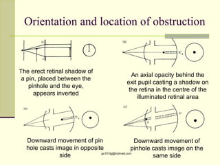 Orientation and location of obstruction



The erect retinal shadow of
                                            An axial opacity behind the
 a pin, placed between the
                                          exit pupil casting a shadow on
    pinhole and the eye,
                                           the retina in the centre of the
      appears inverted
                                              illuminated retinal area




  Downward movement of pin                       Downward movement of
  hole casts image in opposite                  pinhole casts image on the
              side           gs101lg@hotmail.com
                                                        same side
 