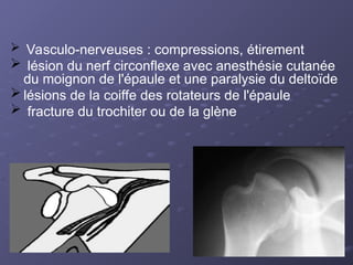  Vasculo-nerveuses : compressions, étirement
 lésion du nerf circonflexe avec anesthésie cutanée
du moignon de l'épaule et une paralysie du deltoïde
 lésions de la coiffe des rotateurs de l'épaule
 fracture du trochiter ou de la glène
 