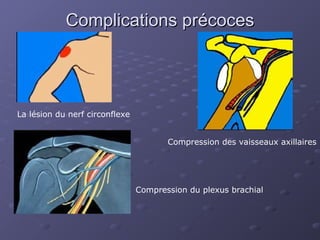 Complications précoces
Complications précoces
La lésion du nerf circonflexe
Compression des vaisseaux axillaires
Compression du plexus brachial
 