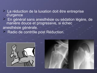  La réduction de la luxation doit être entreprise
d'urgence
 En général sans anesthésie ou sédation légère, de
manière douce et progressive, si échec
anesthésie générale.
 Radio de contrôle post Réduction.
 