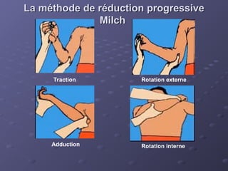 La méthode de réduction progressive
La méthode de réduction progressive
Milch
Milch
Rotation externe
Rotation interne
Adduction
Traction
 