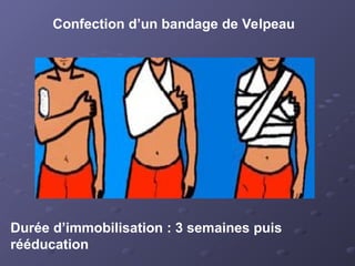 Confection d’un bandage de Velpeau
Durée d’immobilisation : 3 semaines puis
rééducation
 