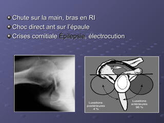Chute sur la main, bras en RI
Chute sur la main, bras en RI
Choc direct ant sur l’épaule
Choc direct ant sur l’épaule
Crises comitiale
Crises comitiale Épilepsie
Épilepsie, électrocution
, électrocution
 