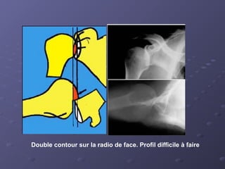 Double contour sur la radio de face. Profil difficile à faire
 