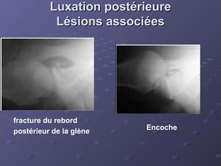 Luxation postérieure
Luxation postérieure
Lésions associées
Lésions associées
fracture du rebord
postérieur de la glène
Encoche
 