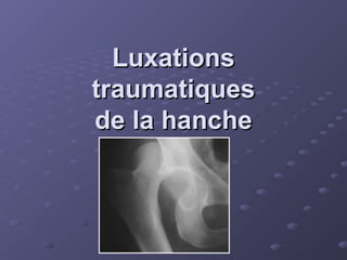 Luxations
Luxations
traumatiques
traumatiques
de la hanche
de la hanche
 