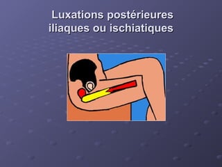 Luxations postérieures
Luxations postérieures
iliaques ou ischiatiques
iliaques ou ischiatiques
 