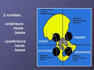 2 variétés:
- antérieure
. haute
. basse
- postérieure
. haute
. basse
 