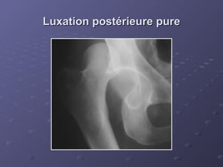Luxation postérieure pure
Luxation postérieure pure
 