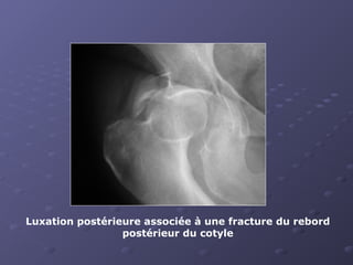 Luxation postérieure associée à une fracture du rebord
postérieur du cotyle
 