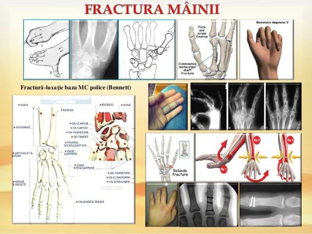 Tratament medicamentos al osteocondrozei