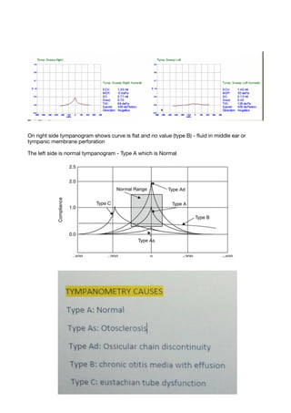 Typanogram Types Normal Ent part ii | PDF