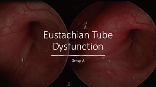 Eustachian Tube
Dysfunction
Group A
 