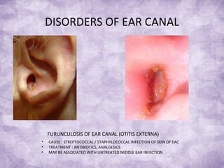 DISORDERS OF EAR CANAL
FURUNCULOSIS OF EAR CANAL (OTITIS EXTERNA)
• CAUSE : STREPTOCOCCAL / STAPHYLOCOCCAL INFECTION OF SKIN OF EAC
• TREATMENT : ANTIBIOTICS, ANALGESICS
• MAY BE ASSOCIATED WITH UNTREATED MIDDLE EAR INFECTION
 