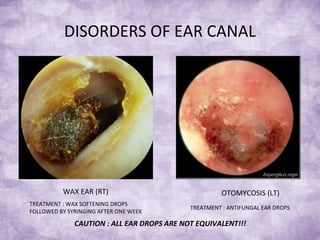 DISORDERS OF EAR CANAL
WAX EAR (RT) OTOMYCOSIS (LT)
TREATMENT : WAX SOFTENING DROPS
FOLLOWED BY SYRINGING AFTER ONE WEEK
TREATMENT : ANTIFUNGAL EAR DROPS
CAUTION : ALL EAR DROPS ARE NOT EQUIVALENT!!!
 