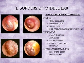 DISORDERS OF MIDDLE EAR
ACUTE SUPPURATIVE OTITIS MEDIA
•STAGES
– TUBAL OCCLUSION
– PRESUPPURATION
– SUPPURATION
– DISCHARGE/RESOLUTION/ COMPLICATIONS
•TREATMENT
– ORAL ANTIBIOTICS
– ANALGESICS
– ANTIHISTAMINICS
– NASAL DECONGESTANTS
– FOLLOWUP
•SPECIAL CONSIDERATIONS
– ROLE OF EAR DROPS
– MYRINGOTOMY
 