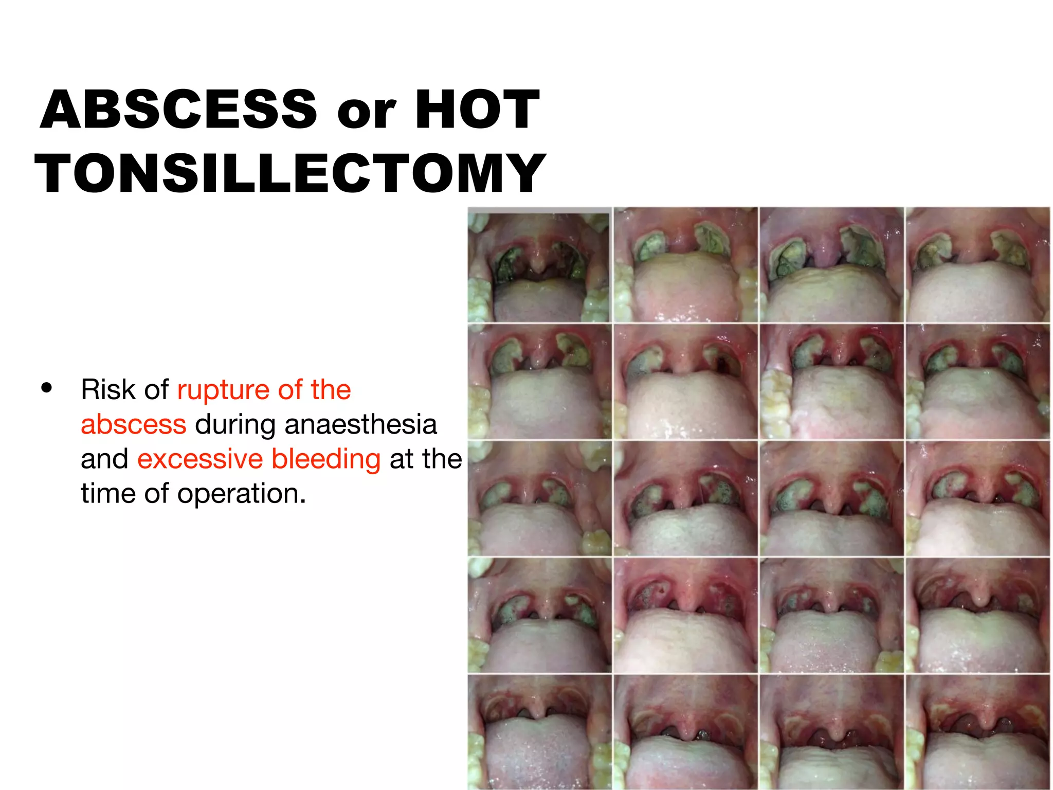 quinsy-peritonsillar-abscess-ppt