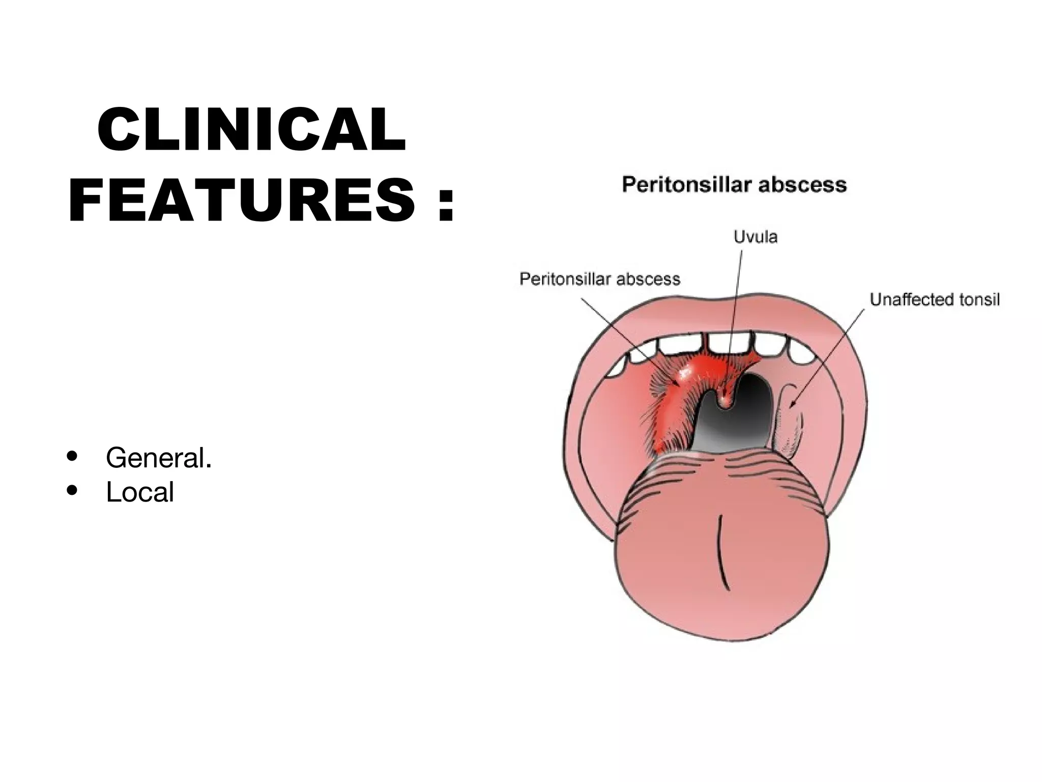 QUINSY Peritonsillar Abscess PPT