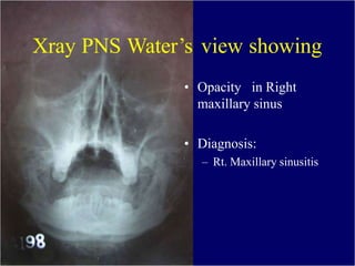 Xray PNS Water’s view showing
• Opacity seen in Rt.
Maxillary sinus
• Tooth on the medial
wall
• Thinned out Sinus
walls
D...