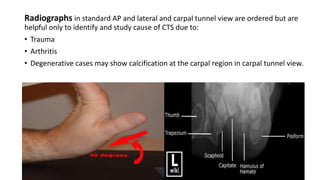 Radiographs in standard AP and lateral and carpal tunnel view are ordered but are
helpful only to identify and study cause of CTS due to:
• Trauma
• Arthritis
• Degenerative cases may show calcification at the carpal region in carpal tunnel view.
 