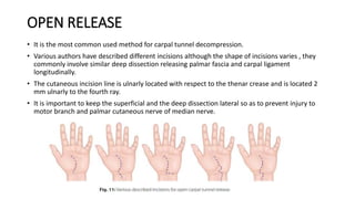 OPEN RELEASE
• It is the most common used method for carpal tunnel decompression.
• Various authors have described different incisions although the shape of incisions varies , they
commonly involve similar deep dissection releasing palmar fascia and carpal ligament
longitudinally.
• The cutaneous incision line is ulnarly located with respect to the thenar crease and is located 2
mm ulnarly to the fourth ray.
• It is important to keep the superficial and the deep dissection lateral so as to prevent injury to
motor branch and palmar cutaneous nerve of median nerve.
 