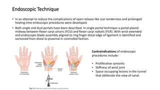 Endoscopic Technique
• In an attempt to reduce the complications of open release like scar tenderness and prolonged
healing time endoscopic procedures were developed.
• Both single and dual portals have been described. In single portal technique a portal placed
midway between flexor carpi ulnaris (FCU) and flexor carpi radialis (FCR). With wrist extended
and endoscopic blade assembly aligned to ring finger distal edge of ligament is identified and
sectioned from distal to proximal in controlled fashion.
Contraindications of endoscopic
procedures include:
• Proliferative synovitis
• Stiffness of wrist joint
• Space occupying lesions in the tunnel
that obliterate the view of canal.
 