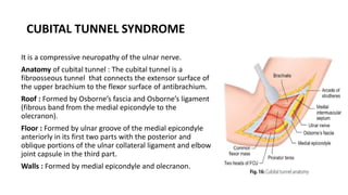 CUBITAL TUNNEL SYNDROME
It is a compressive neuropathy of the ulnar nerve.
Anatomy of cubital tunnel : The cubital tunnel is a
fibroosseous tunnel that connects the extensor surface of
the upper brachium to the flexor surface of antibrachium.
Roof : Formed by Osborne’s fascia and Osborne’s ligament
(fibrous band from the medial epicondyle to the
olecranon).
Floor : Formed by ulnar groove of the medial epicondyle
anteriorly in its first two parts with the posterior and
oblique portions of the ulnar collateral ligament and elbow
joint capsule in the third part.
Walls : Formed by medial epicondyle and olecranon.
 