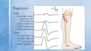 Diagnosis:-
› Edx:-
– Peroneal motor study,
› Recording: EDB
› Stimulating: Ankle, Below Fibular head and Lateral poplitea...