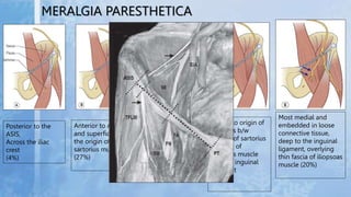 MERALGIA PARESTHETICA
Posterior to the
ASIS,
Across the iliac
crest
(4%)
Anterior to ASIS
and superficial to
the origin of...