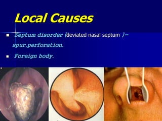 Local Causes
 Septum disorder (deviated nasal septum )-
spur,perforation.
 Foreign body.
.
 