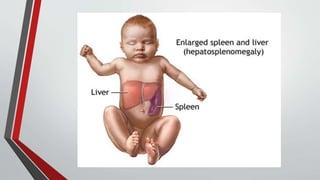 Entric Entric Fever.pptx