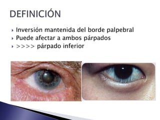  Inversión mantenida del borde palpebral
Puede afectar a ambos párpados
>>>> párpado inferior