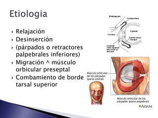  Relajación
Desinserción
(párpados o retractores
palpebrales inferiores)
Migración ^ músculo
orbicular preseptal
Combamiento de borde
tarsal superior