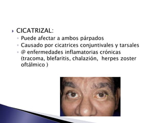 CICATRIZAL:
◦ Puede afectar a ambos párpados
◦ Causado por cicatrices conjuntivales y tarsales
◦ @ enfermedades inflamatorias crónicas
(tracoma, blefaritis, chalazión, herpes zoster
oftálmico )