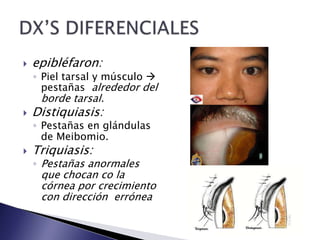  epibléfaron:
◦ Piel tarsal y músculo
pestañas alrededor del
borde tarsal.
Distiquiasis:
◦ Pestañas en glándulas
de Meibomio.
Triquiasis:
◦ Pestañas anormales
que chocan co la
córnea por crecimiento
con dirección errónea