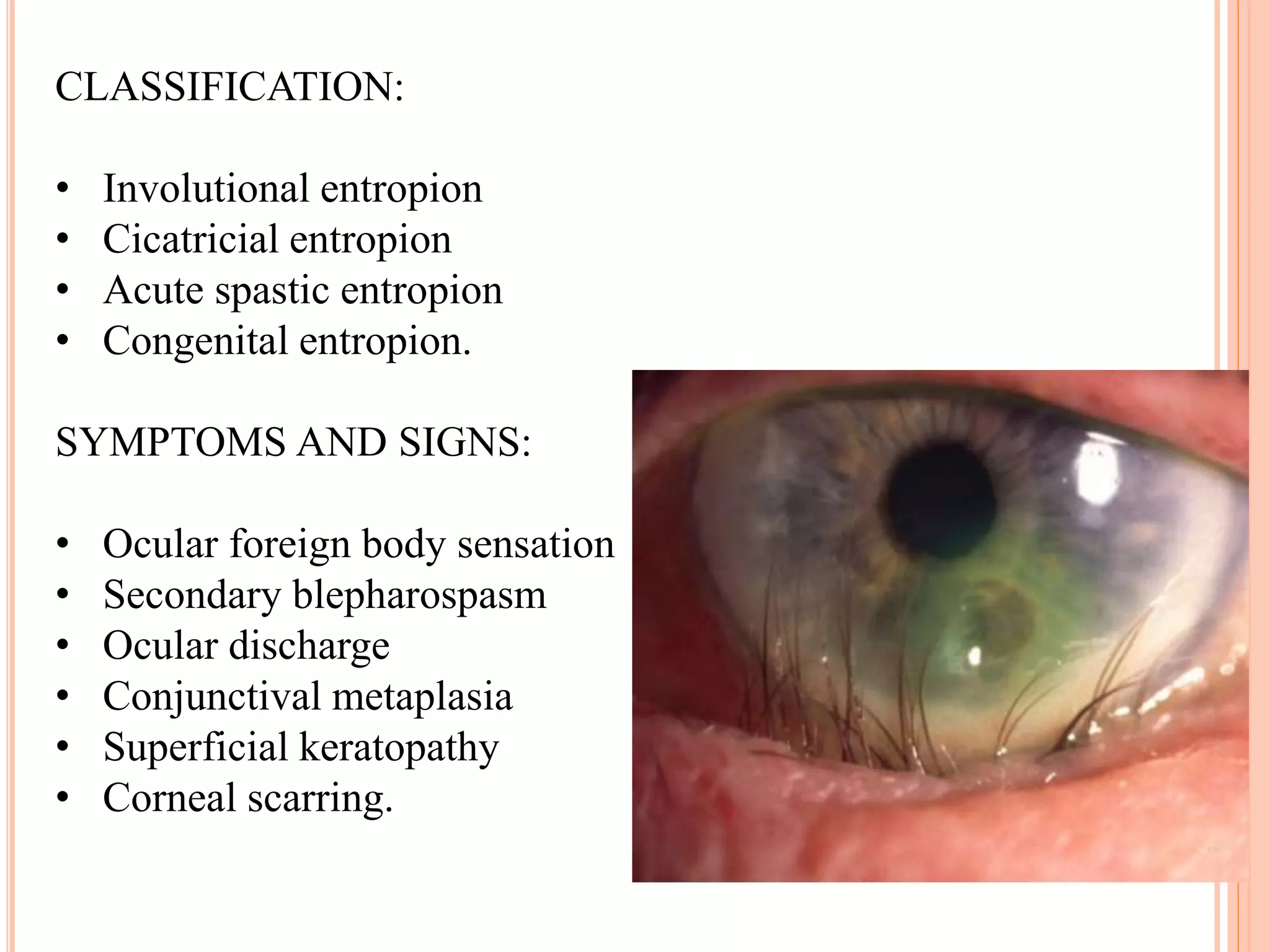 Entropion PPTX
