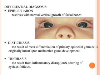 DIFFERENTIAL DIAGNOSIS:
 EPIBLEPHARON
resolves with normal vertical growth of facial bones.
 DISTICHIASIS
the result of ...