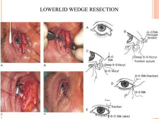 LOWERLID WEDGE RESECTION
 