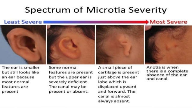 External Ear disease