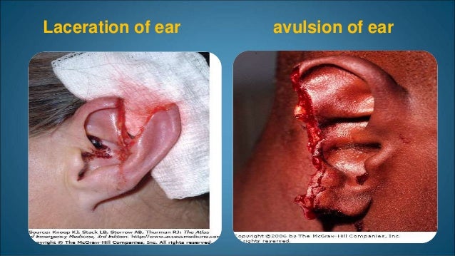 External Ear disease