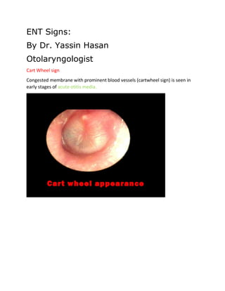 ENT Signs:
By Dr. Yassin Hasan
Otolaryngologist
Cart Wheel sign
Congested membrane with prominent blood vessels (cartwheel sign) is seen in
early stages of acute otitis media.
 