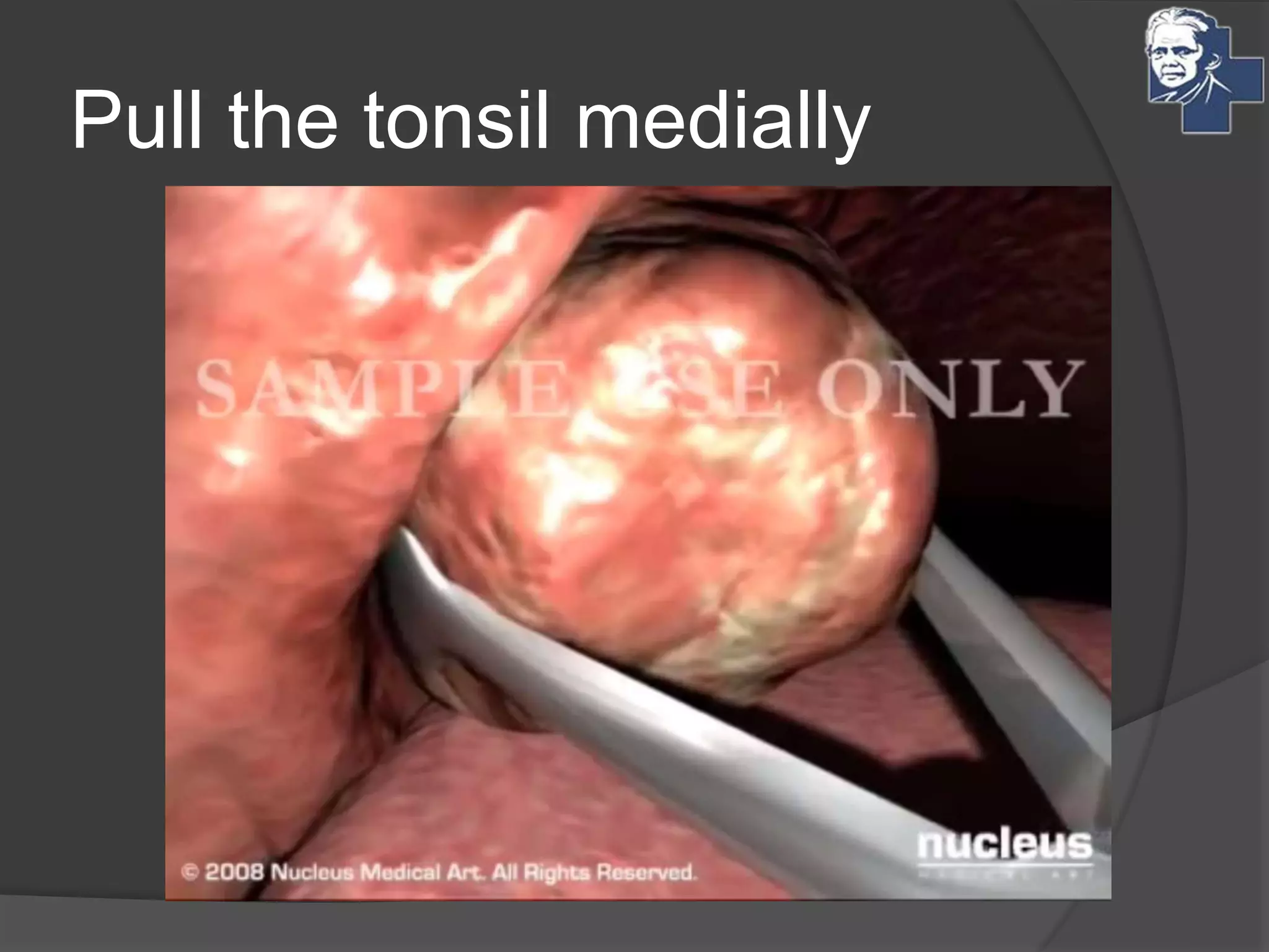 Pull the tonsil medially
 