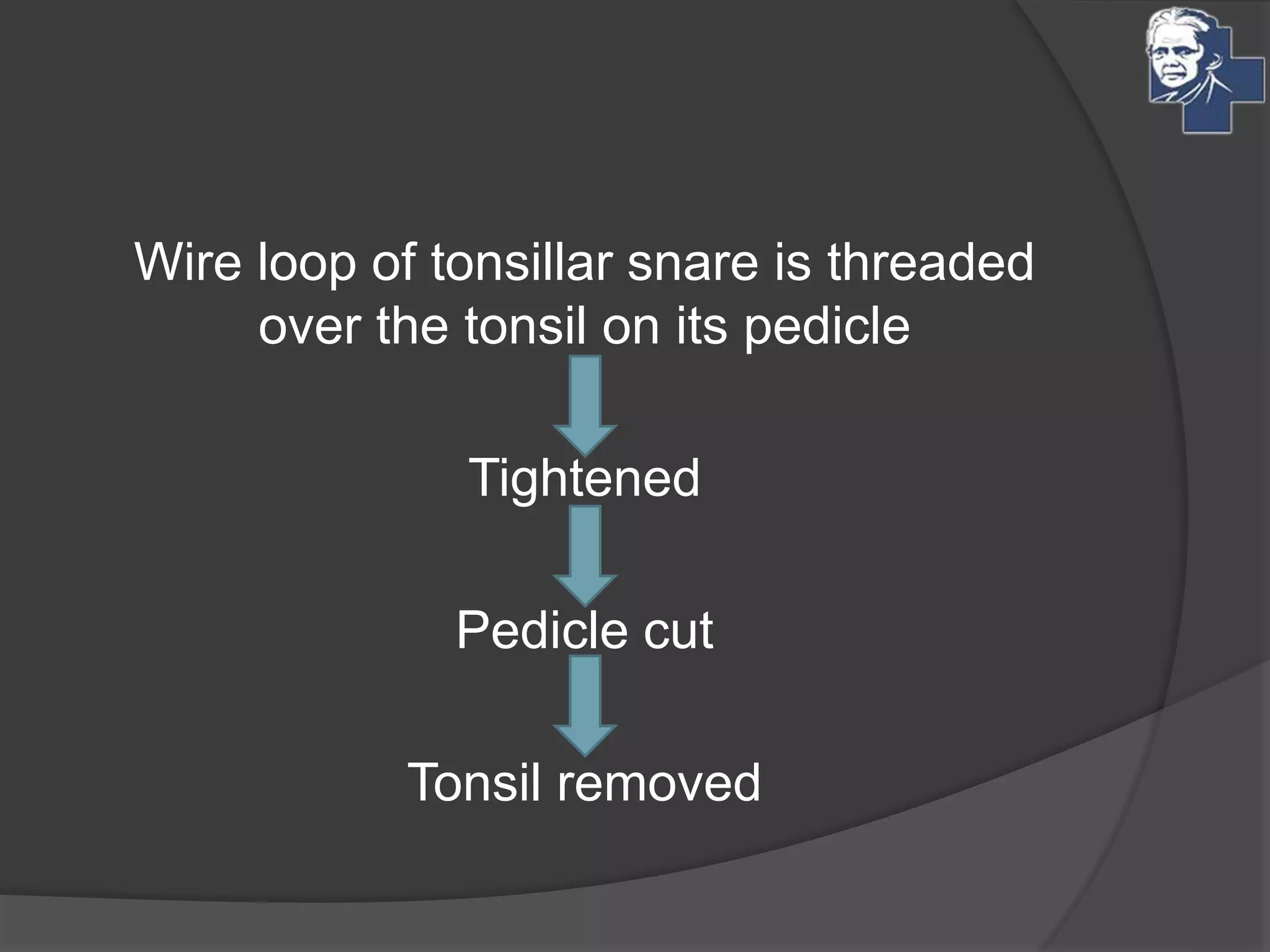 Wire loop of tonsillar snare is threaded
over the tonsil on its pedicle
Tightened
Pedicle cut
Tonsil removed
 